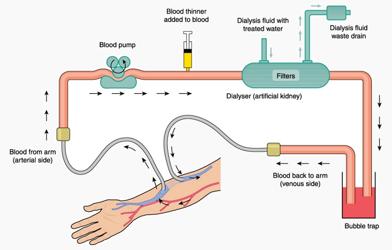 Hemodialysis