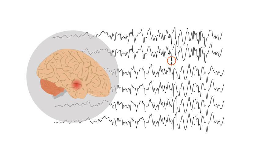 Red spot at temporal lobe of brain indicating a seizure caused by epilepsy