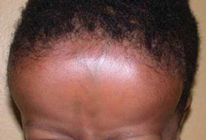 frontal bone bossing bosses eminence tuber