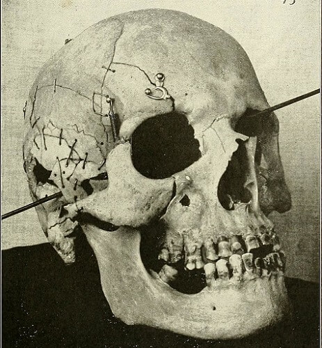 gunshot wound skull trajectory