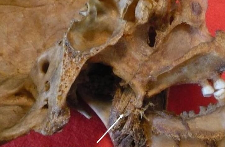 medial surface mandible
