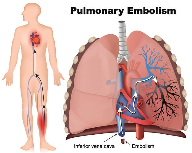 embolism lung pulmonary mechanism