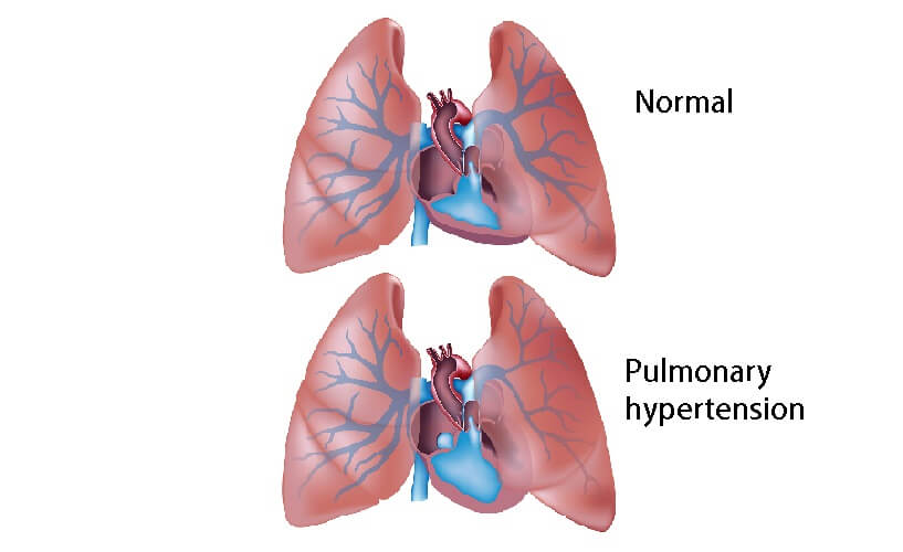 pulmonary hypertension PAH arterial vascular