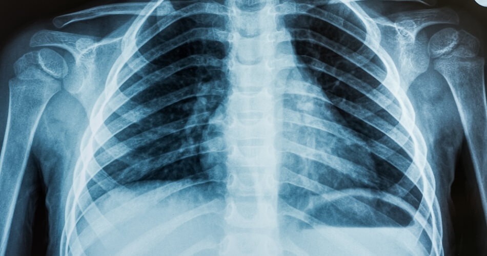 xray thoracic chest ribs heart