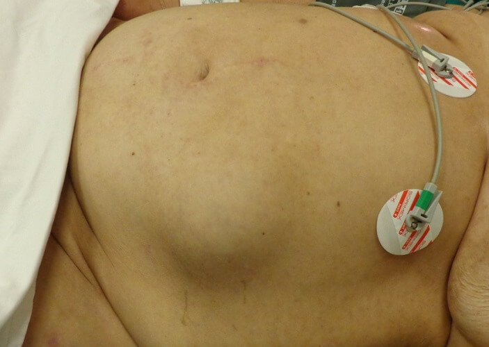 ventral hernia abdominal hernia